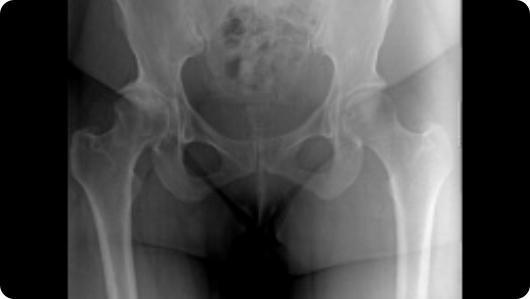Radiographic image of hip arthritis