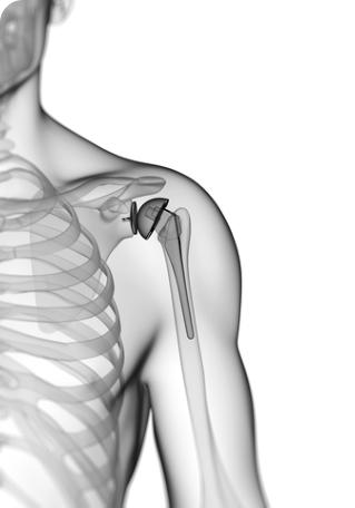 Black and white 3D image on a white background. It shows a shoulder with the skeletal system visible beneath it.