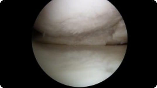 Arthroscopic image of a miniscus tear after knee arthroscopy