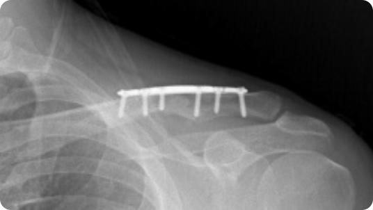 Radiographic image of a clavicle ORIF (plate and screws)
