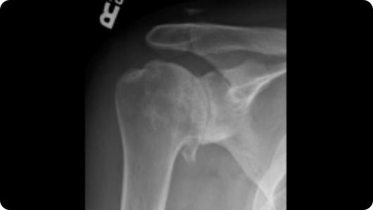 Radiographic image of shoulder arthritis