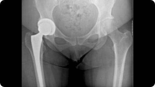 Radiographic image of a total hip replacement
