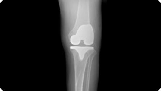 Radiographic image of a total knee replacement