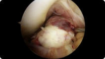 Arthroscopic image of an ACL tear