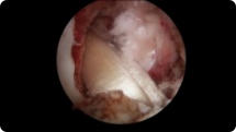 Arthroscopic image of an ACL reconstruction