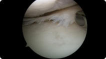 Arthroscopic image of a miniscus tear