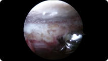 Arthroscopic image of a removed bone spur