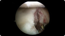 Arthroscopic image of a shoulder dislocation