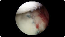 Arthroscopic image of a repaired shoulder dislocation