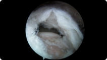Arthroscopic image of a rotator cuff tear