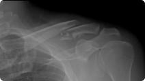 Radiographic image of a clavicle fracture