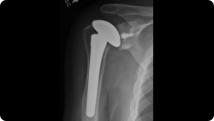 Radiographic image of a total shoulder replacement