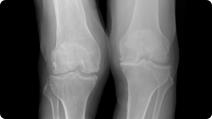 Radiographic image of knee arthritis