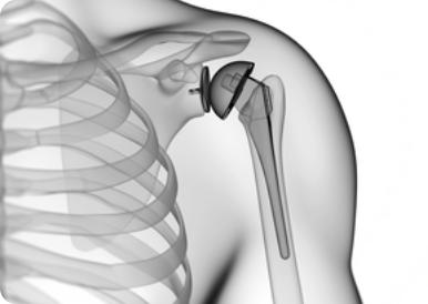 Black and white 3D image on a white background. It shows a shoulder with the skeletal system visible beneath it.